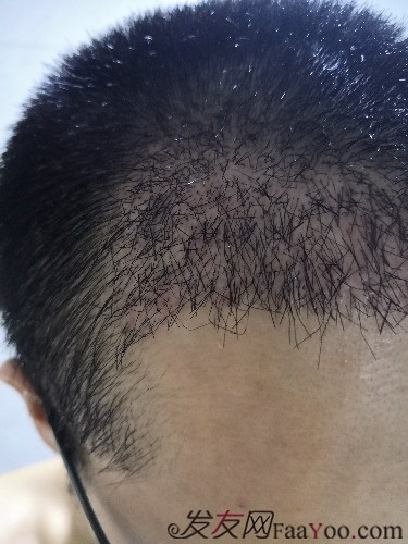 南昌科發(fā)源植發(fā)（現(xiàn)大麥微針），看看大額頭怎么蛻變的