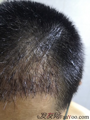 南昌科發(fā)源植發(fā)（現(xiàn)大麥微針），看看大額頭怎么蛻變的