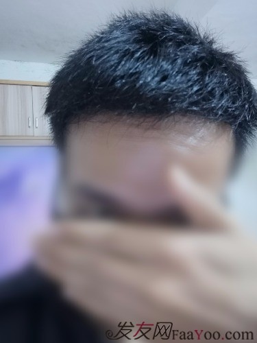 南昌科發(fā)源植發(fā)（現(xiàn)大麥微針），看看大額頭怎么蛻變的