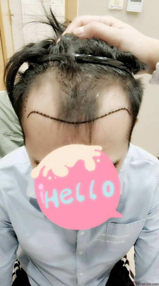 南寧大麥微針植發(fā)，分享我的前后對(duì)比圖