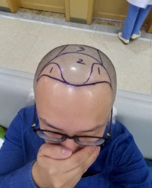 好運(yùn)哥大麥微針3850單位，鼓起勇氣的蛻變