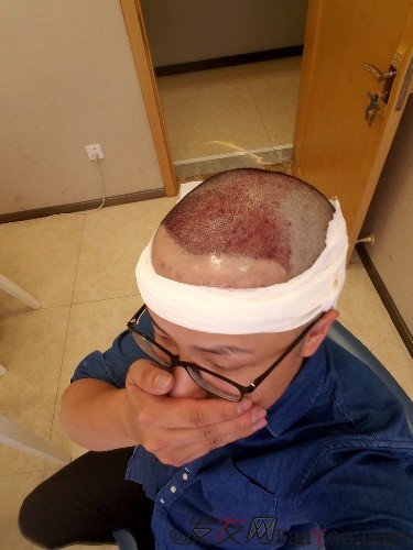 好運(yùn)哥大麥微針3850單位，鼓起勇氣的蛻變