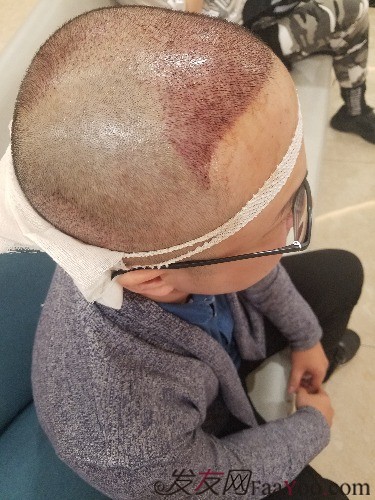 好運(yùn)哥大麥微針3850單位，鼓起勇氣的蛻變