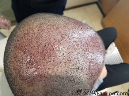 好運(yùn)哥大麥微針3850單位，鼓起勇氣的蛻變