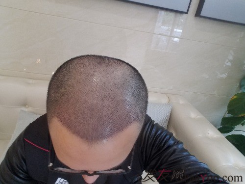 好運(yùn)哥大麥微針3850單位，鼓起勇氣的蛻變