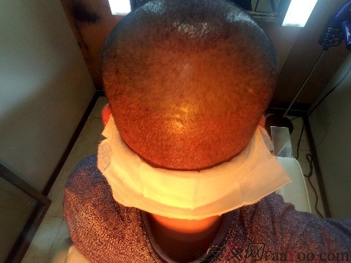 好運(yùn)哥大麥微針3850單位，鼓起勇氣的蛻變