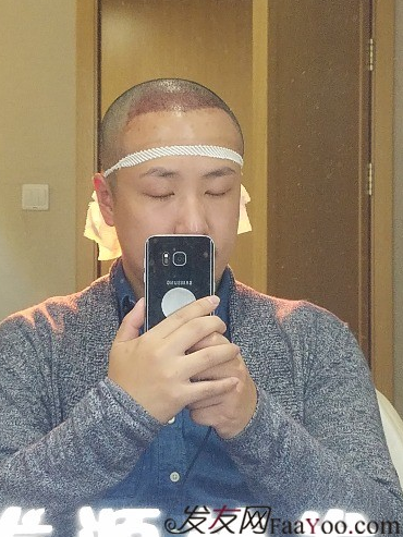 好運(yùn)哥大麥微針3850單位，鼓起勇氣的蛻變