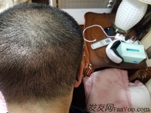 好運(yùn)哥大麥微針3850單位，鼓起勇氣的蛻變