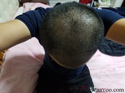 好運(yùn)哥大麥微針3850單位，鼓起勇氣的蛻變