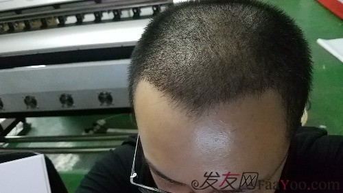 好運(yùn)哥大麥微針3850單位，鼓起勇氣的蛻變