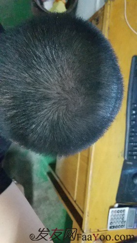 好運(yùn)哥大麥微針3850單位，鼓起勇氣的蛻變