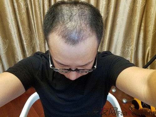 好運(yùn)哥大麥微針3850單位，鼓起勇氣的蛻變