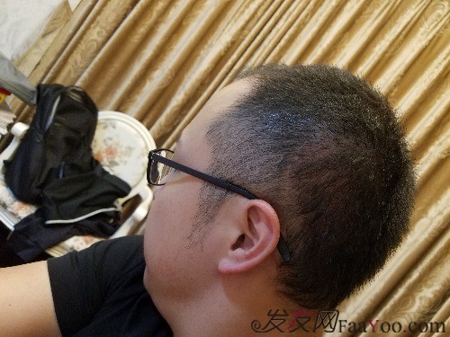 好運(yùn)哥大麥微針3850單位，鼓起勇氣的蛻變