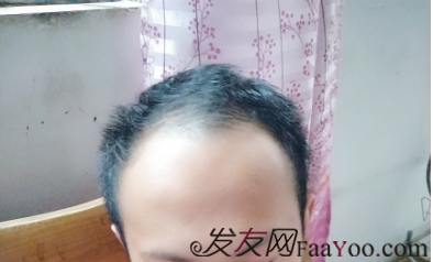 廣州大麥微針自信從頭開始PSE+PTT&nbsp;，聽我仔細(xì)講述