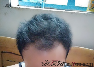 廣州大麥微針自信從頭開始PSE+PTT&nbsp;，聽我仔細(xì)講述