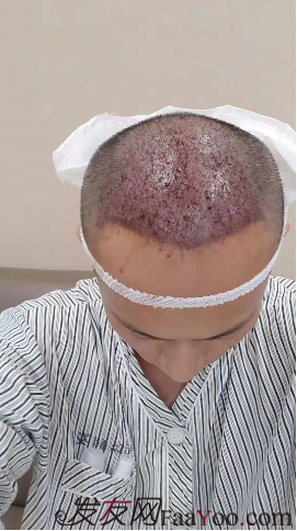 廣州大麥微針自信從頭開始PSE+PTT&nbsp;，聽我仔細(xì)講述