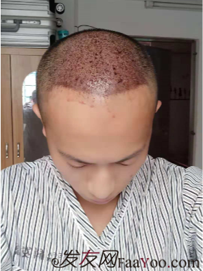 廣州大麥微針自信從頭開始PSE+PTT&nbsp;，聽我仔細(xì)講述