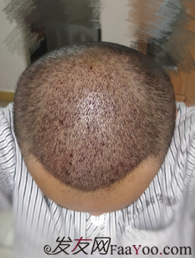 廣州大麥微針自信從頭開始PSE+PTT&nbsp;，聽我仔細(xì)講述