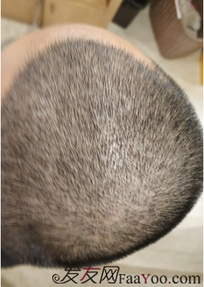 廣州大麥微針自信從頭開始PSE+PTT&nbsp;，聽我仔細(xì)講述