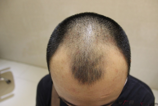 長沙大麥微針植發(fā)記錄，終于謹(jǐn)慎的做出選擇了