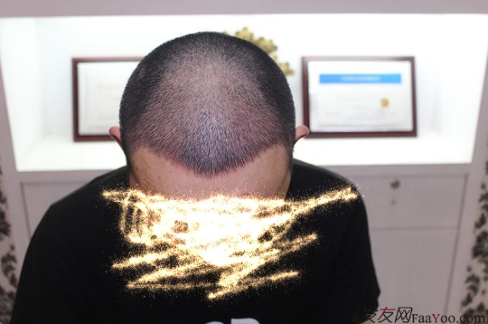 長沙大麥微針植發(fā)記錄，終于謹(jǐn)慎的做出選擇了