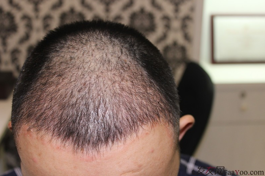 長沙大麥微針植發(fā)記錄，終于謹(jǐn)慎的做出選擇了