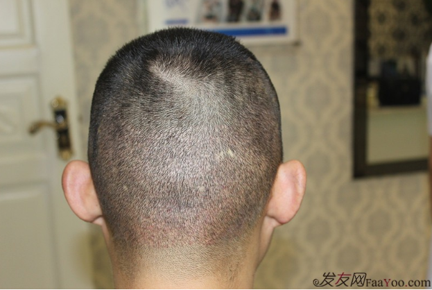 長沙大麥微針植發(fā)記錄，終于謹(jǐn)慎的做出選擇了