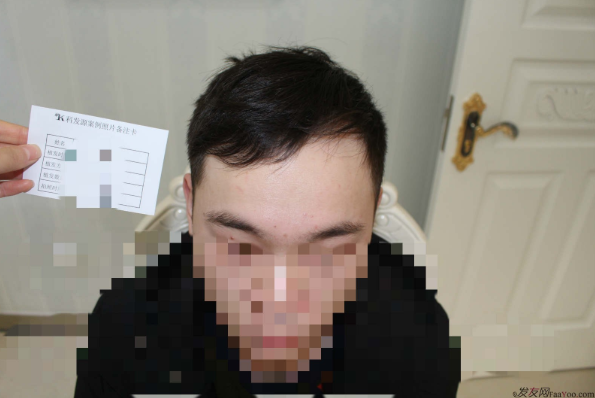 杭州大麥微針植發(fā)2300單位案例，來自脫發(fā)者的內(nèi)心陳述