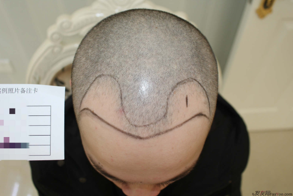 杭州大麥微針植發(fā)2300單位案例，來自脫發(fā)者的內(nèi)心陳述