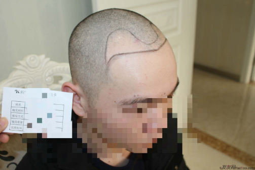 杭州大麥微針植發(fā)2300單位案例，來自脫發(fā)者的內(nèi)心陳述