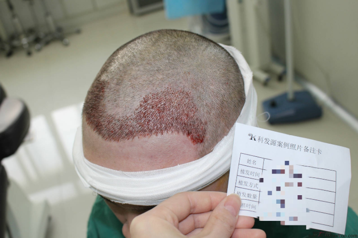 杭州大麥微針植發(fā)2300單位案例，來自脫發(fā)者的內(nèi)心陳述