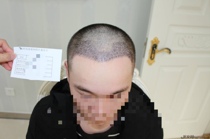 杭州大麥微針植發(fā)2300單位案例，來自脫發(fā)者的內(nèi)心陳述