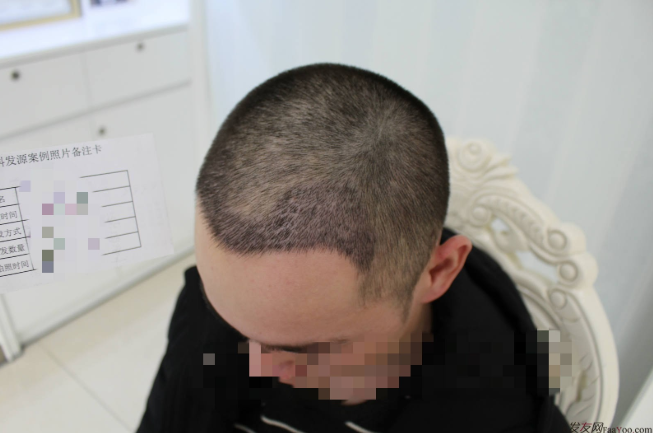 杭州大麥微針植發(fā)2300單位案例，來自脫發(fā)者的內(nèi)心陳述