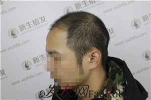 6級脫發(fā)，廣州新生植發(fā)對我做了什么！