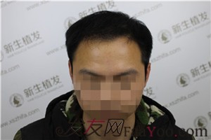6級脫發(fā)，廣州新生植發(fā)對我做了什么！