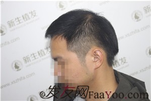 6級脫發(fā)，廣州新生植發(fā)對我做了什么！