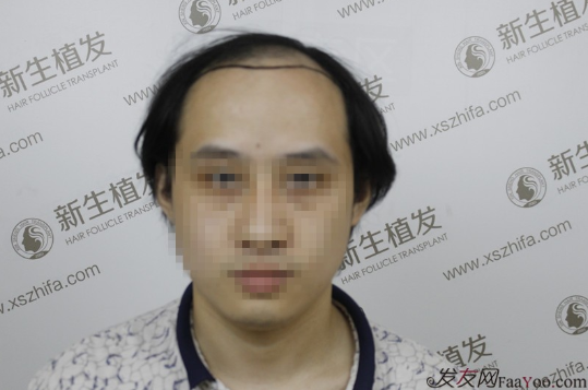 南京新生植發(fā)案例，超大面積脫發(fā)南京新生改變了我的人生
