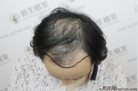 南京新生植發(fā)案例，超大面積脫發(fā)南京新生改變了我的人生