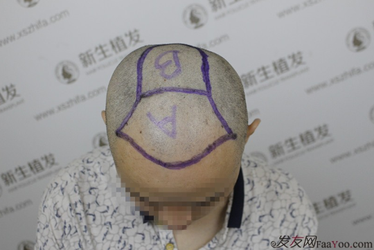 南京新生植發(fā)案例，超大面積脫發(fā)南京新生改變了我的人生