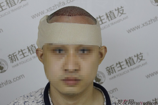 南京新生植發(fā)案例，超大面積脫發(fā)南京新生改變了我的人生