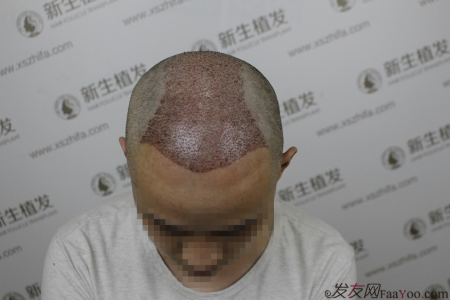 南京新生植發(fā)案例，超大面積脫發(fā)南京新生改變了我的人生