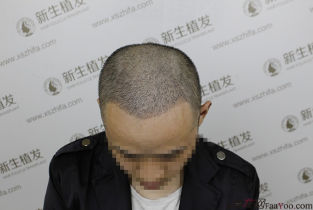 南京新生植發(fā)案例，超大面積脫發(fā)南京新生改變了我的人生