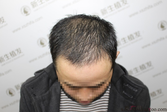南京新生植發(fā)案例，超大面積脫發(fā)南京新生改變了我的人生