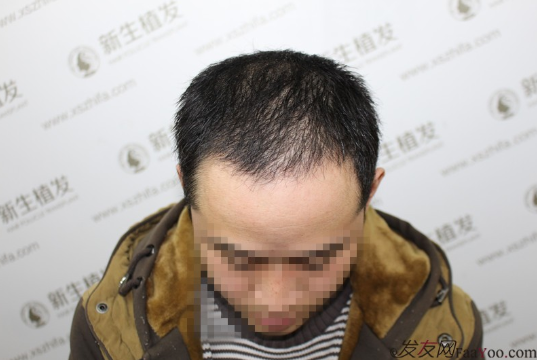 南京新生植發(fā)案例，超大面積脫發(fā)南京新生改變了我的人生