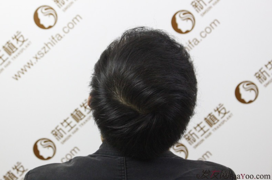 南京新生植發(fā)案例，超大面積脫發(fā)南京新生改變了我的人生