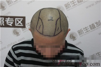 杭州新生植發(fā)2800單位，陳先生術(shù)前術(shù)后顏值大大提高了