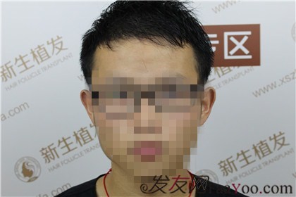 杭州新生植發(fā)2800單位，陳先生術(shù)前術(shù)后顏值大大提高了