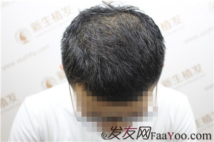 杭州新生植發(fā)2800單位，陳先生術(shù)前術(shù)后顏值大大提高了