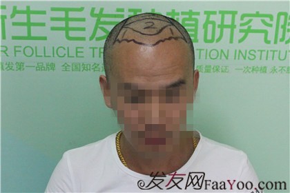 杭州新生植發(fā)2800單位，自信的魅力重新歸來