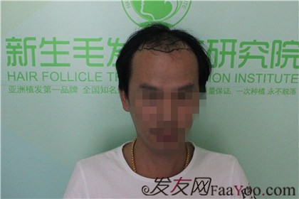 杭州新生植發(fā)2800單位，自信的魅力重新歸來